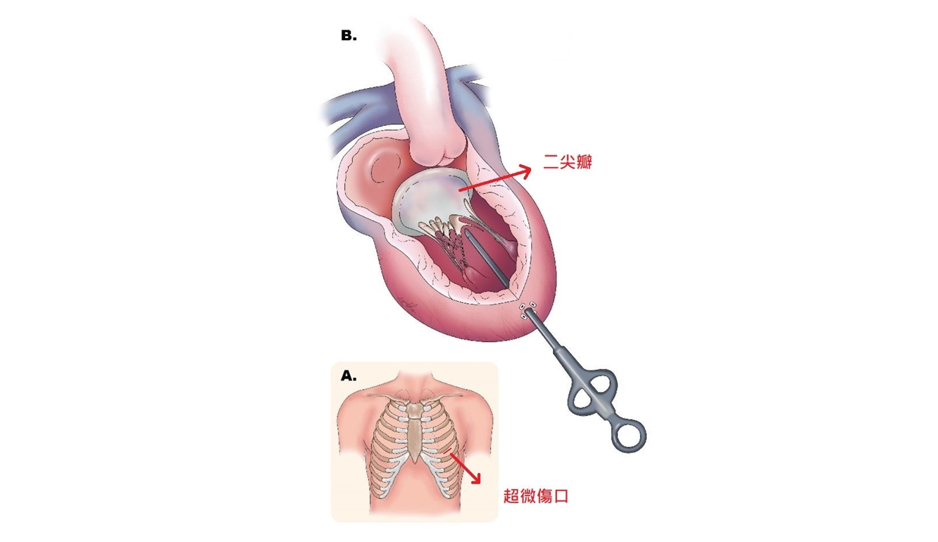 林口長庚超微二尖瓣修補手術　心臟不停跳